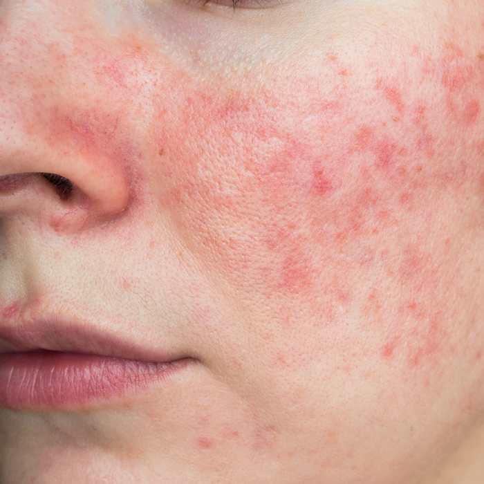 A woman with rosacea skin condition